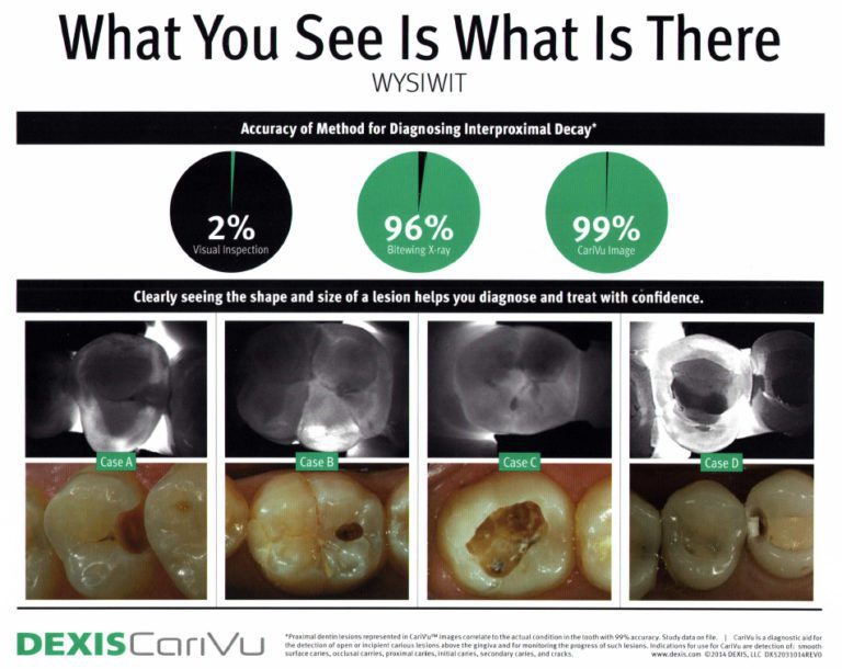 CariVu Caries Detection Device Juanita Family Dentistry