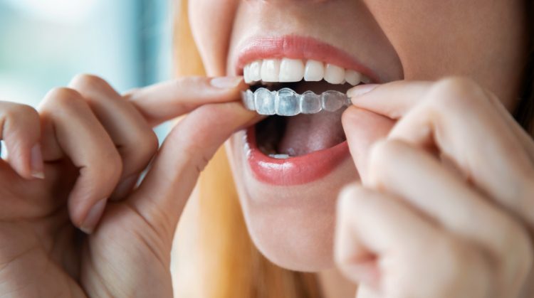 Woman putting on clear aligners – Invisalign vs. braces comparison.