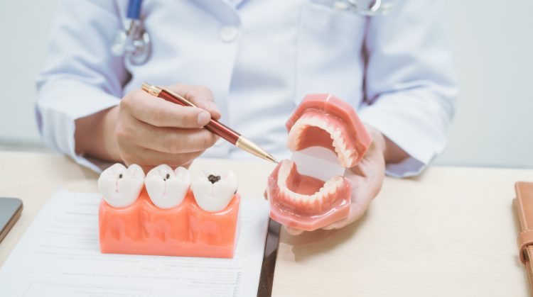 Truth About Cavities